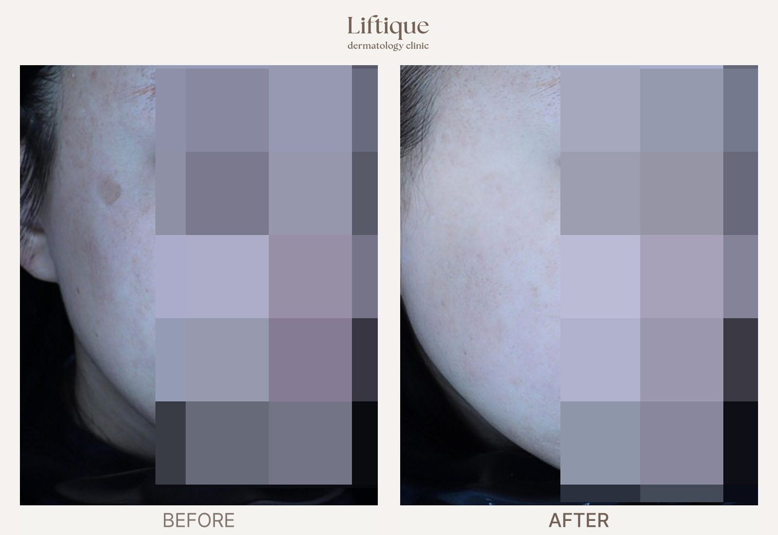 Before-and-after result 7 for Laser Toning at Liftique Dermatology Clinic