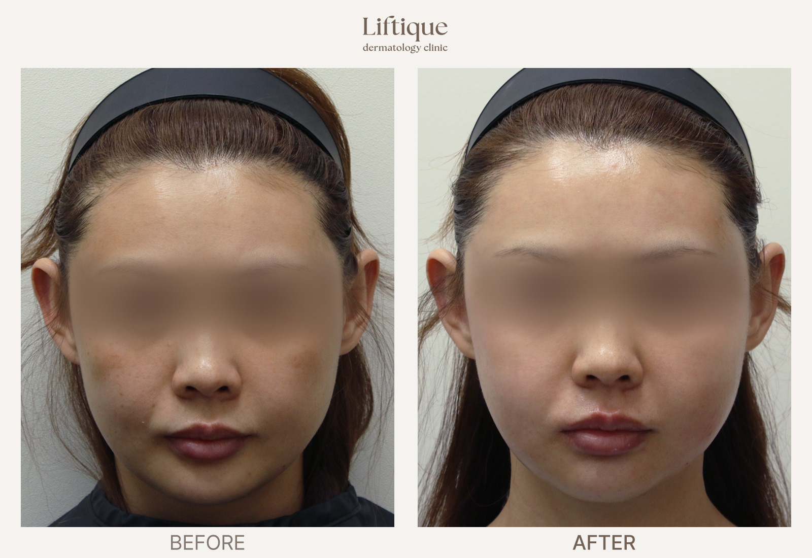 Before-and-after result 2 for Laser Toning at Liftique Dermatology Clinic