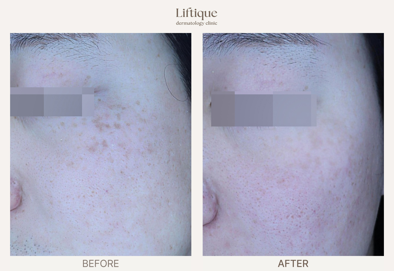 Before-and-after result 5 for Laser Toning at Liftique Dermatology Clinic
