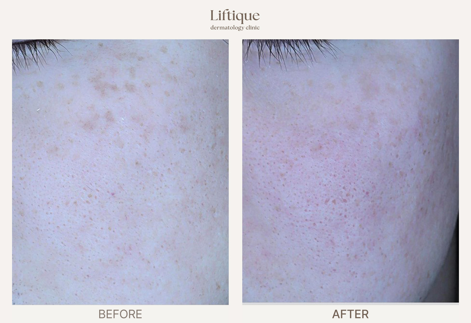 Before-and-after result 4 for Laser Toning at Liftique Dermatology Clinic