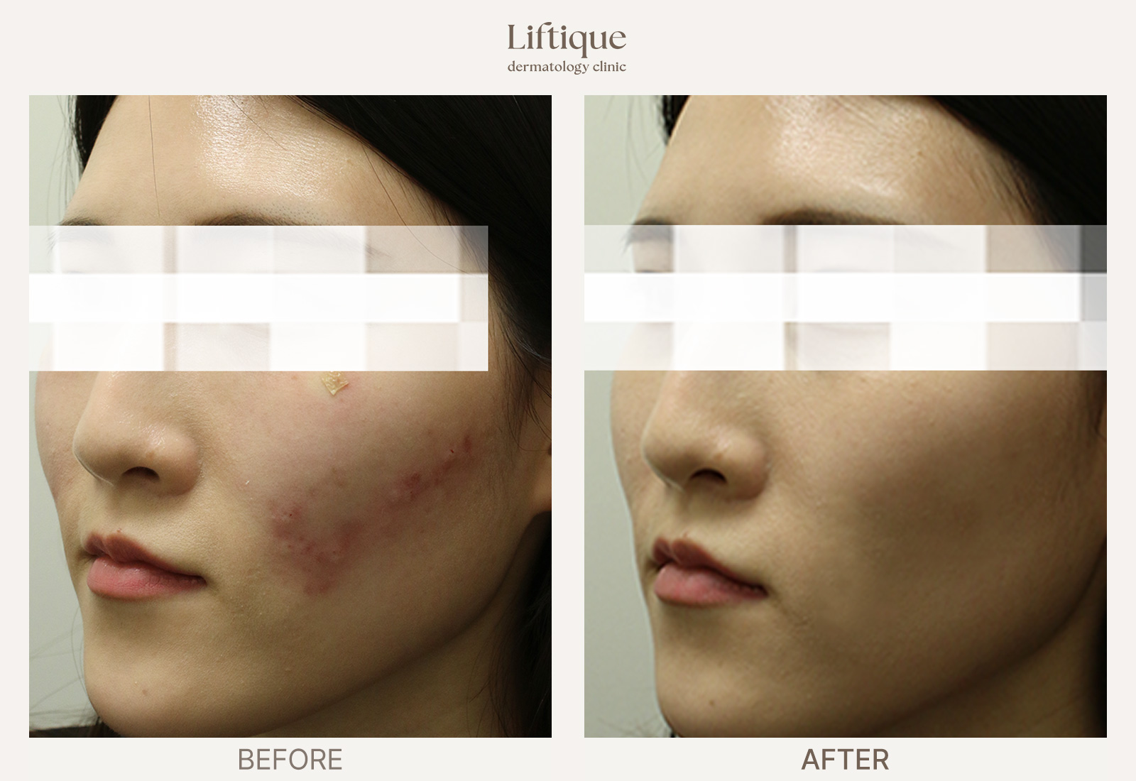 Before-and-after result 2 for Rosacea & Redness Laser at Liftique Dermatology Clinic