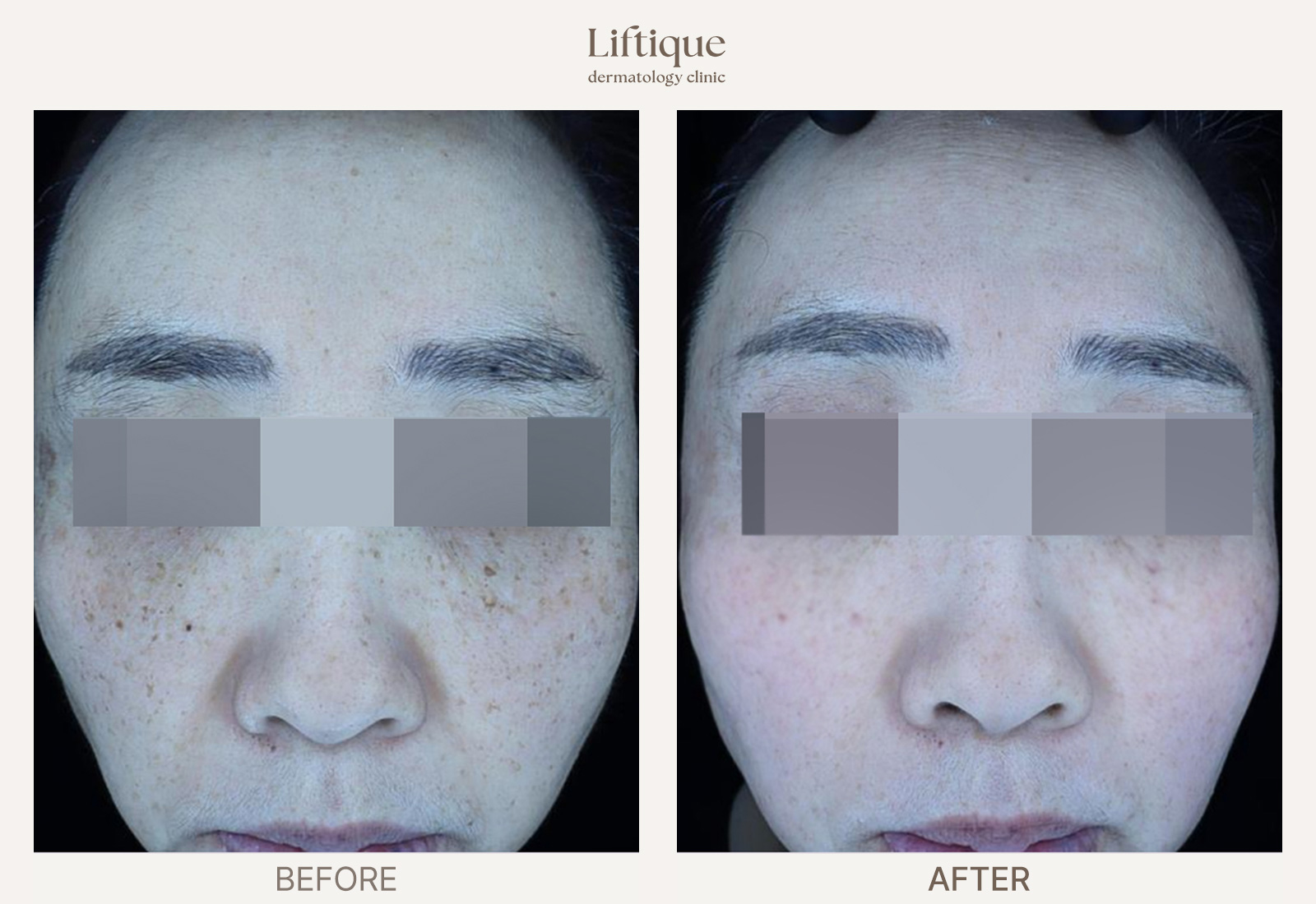 Before-and-after result 6 for Laser Toning at Liftique Dermatology Clinic