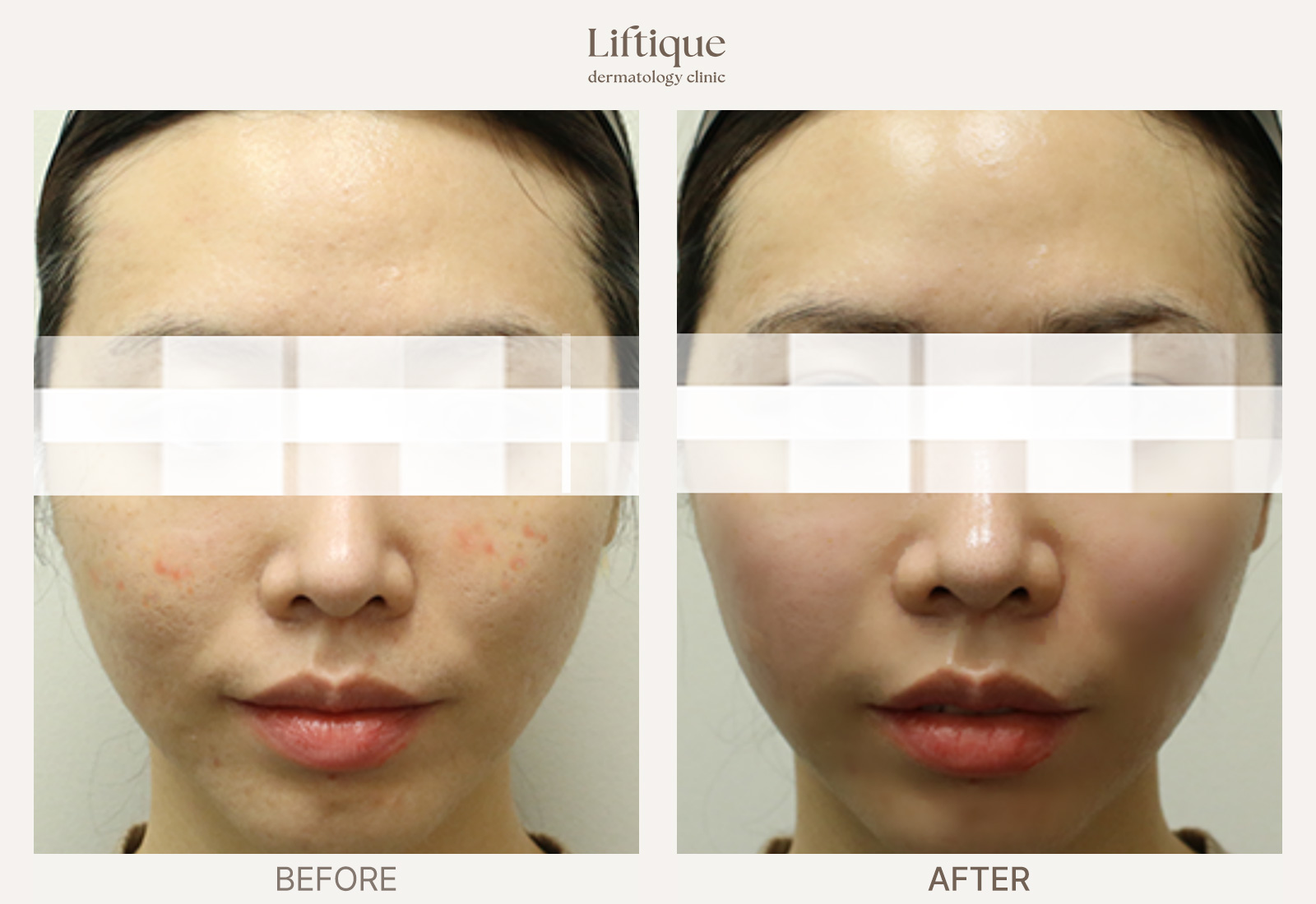 Before-and-after result 4 for Rosacea & Redness Laser at Liftique Dermatology Clinic