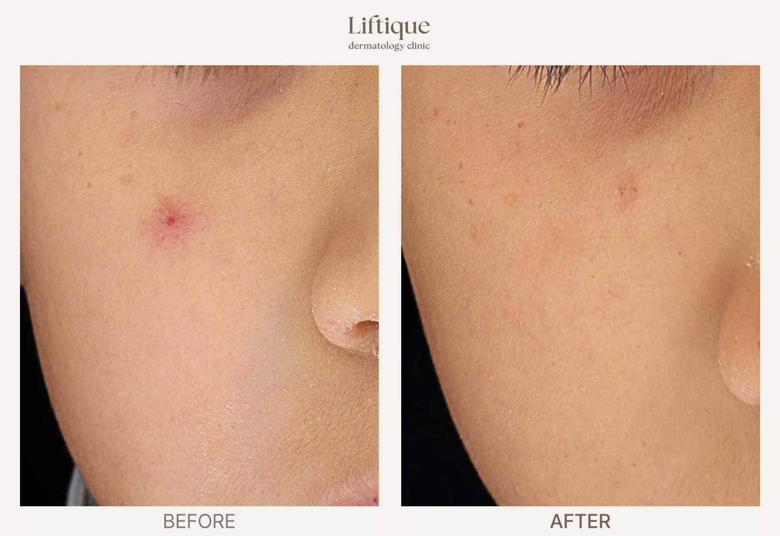 Before-and-after result 1 for Rosacea & Redness Laser at Liftique Dermatology Clinic