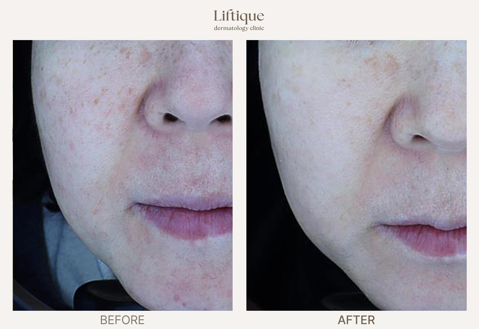 Before-and-after result 5 for Rosacea & Redness Laser at Liftique Dermatology Clinic