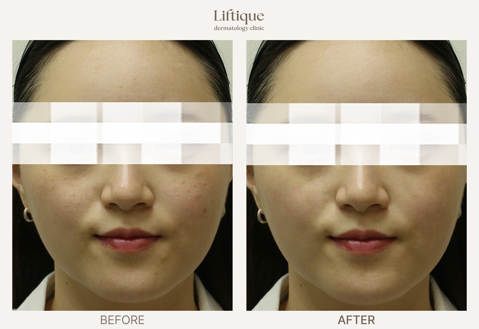 Before-and-after result 3 for Rosacea & Redness Laser at Liftique Dermatology Clinic
