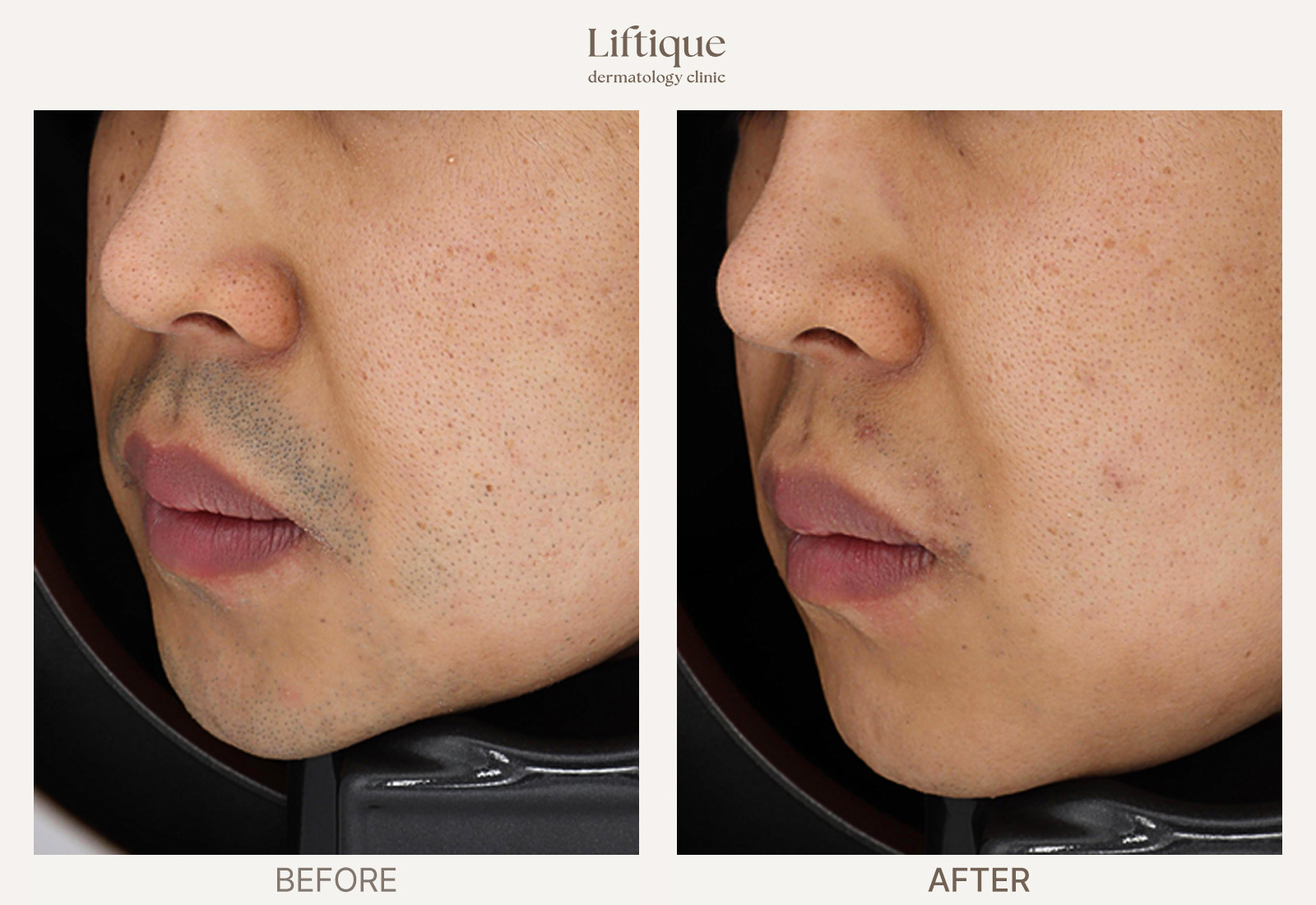 Before-and-after result 1 for Laser Hair Removal at Liftique Dermatology Clinic