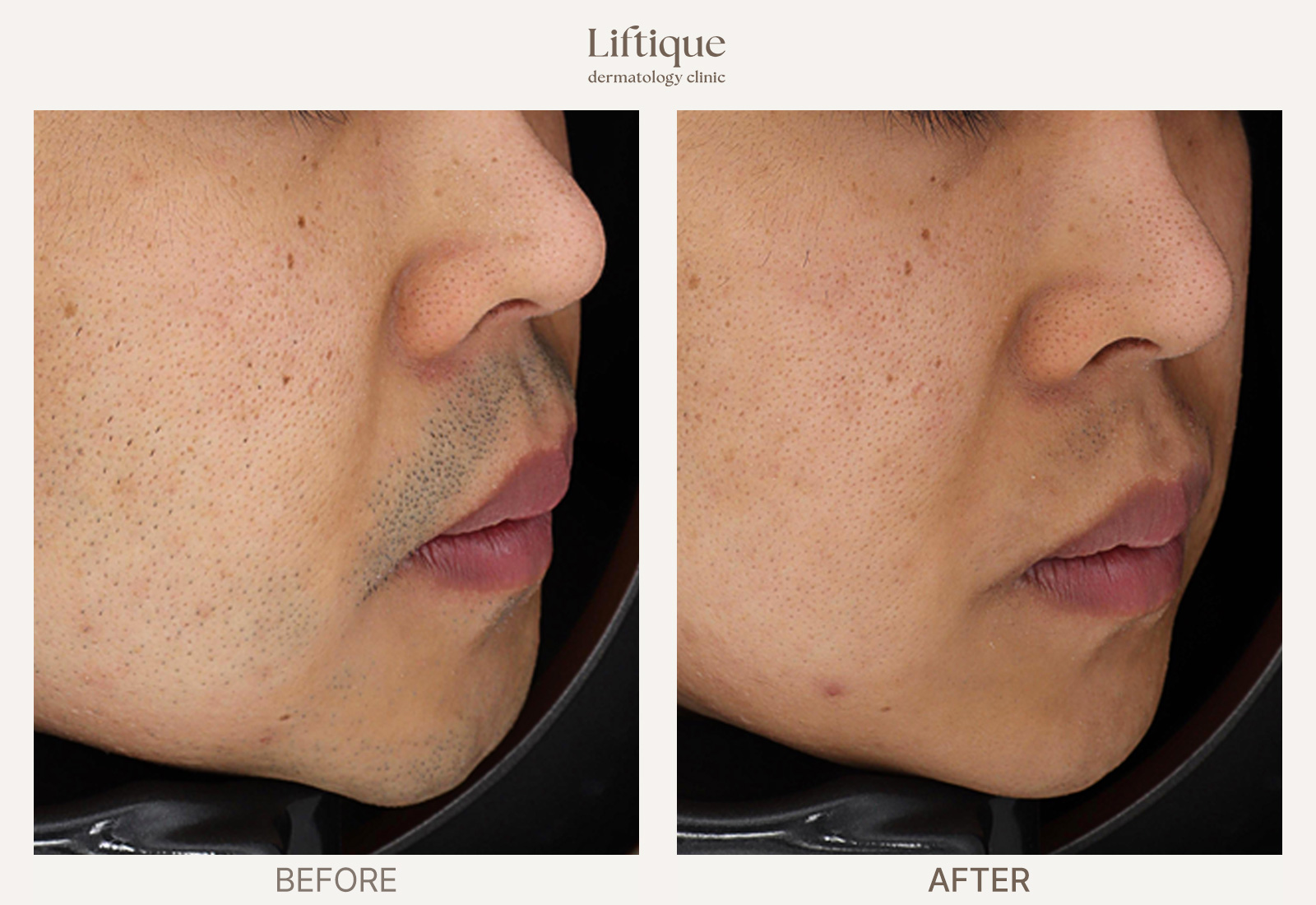 Before-and-after result 2 for Laser Hair Removal at Liftique Dermatology Clinic