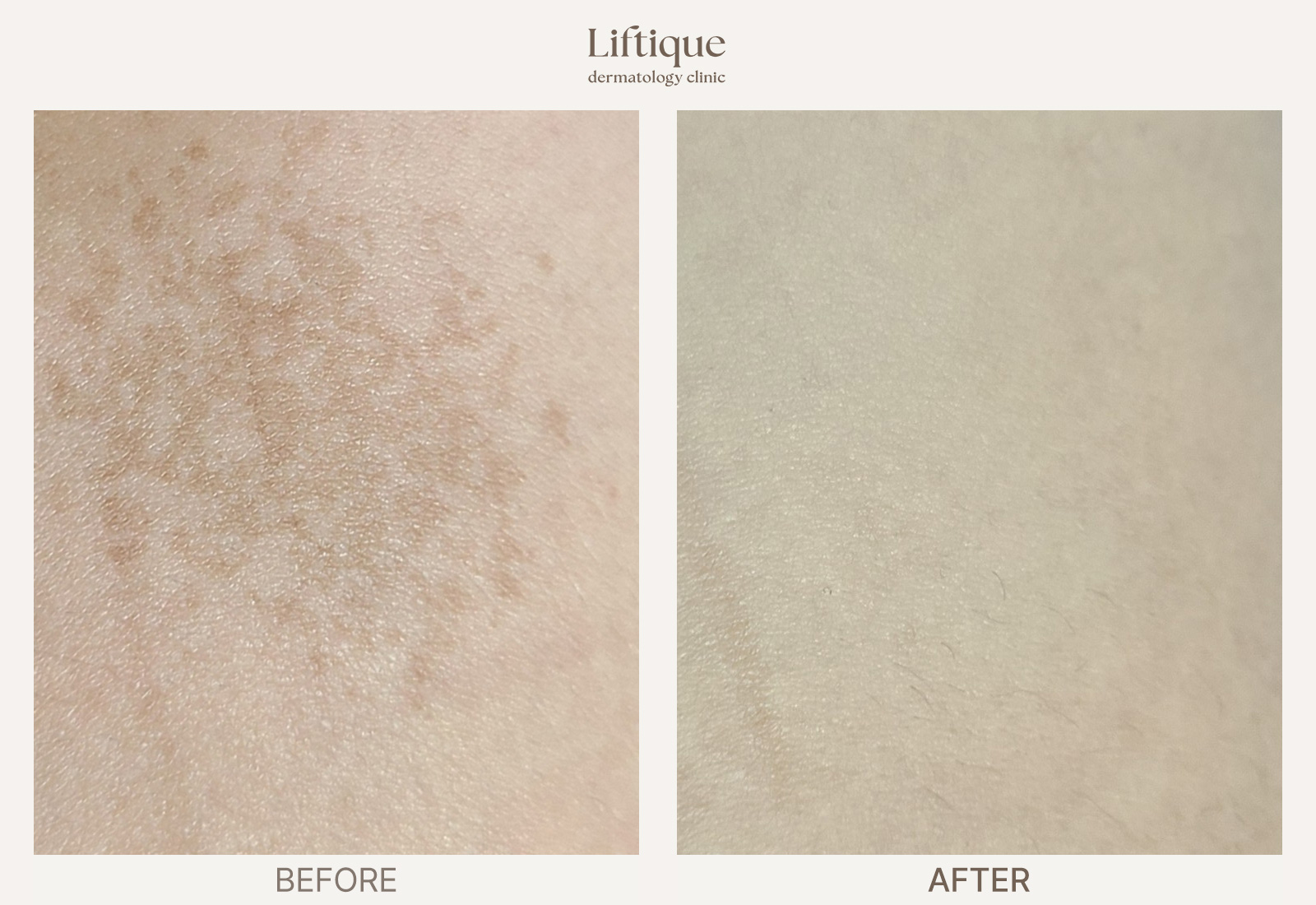 Before-and-after result 1 for Hollywood Q at Liftique Dermatology Clinic