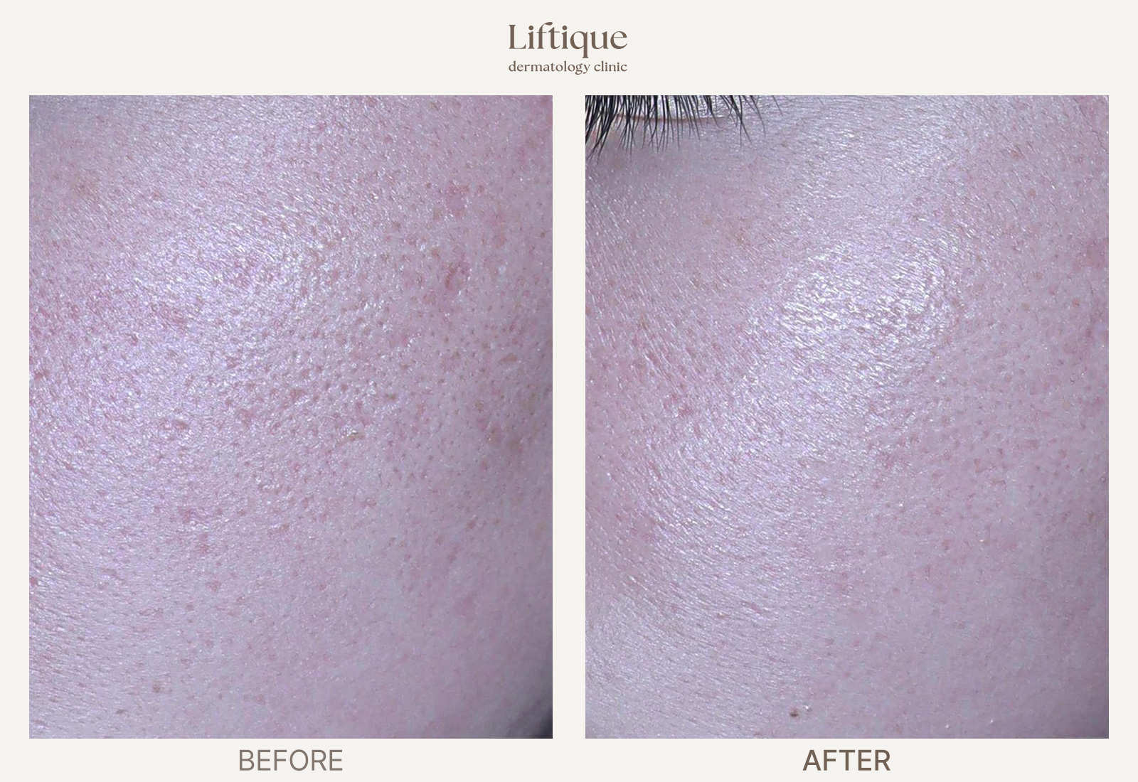 Before-and-after result 1 for Acne Scar Combination Program at Liftique Dermatology Clinic