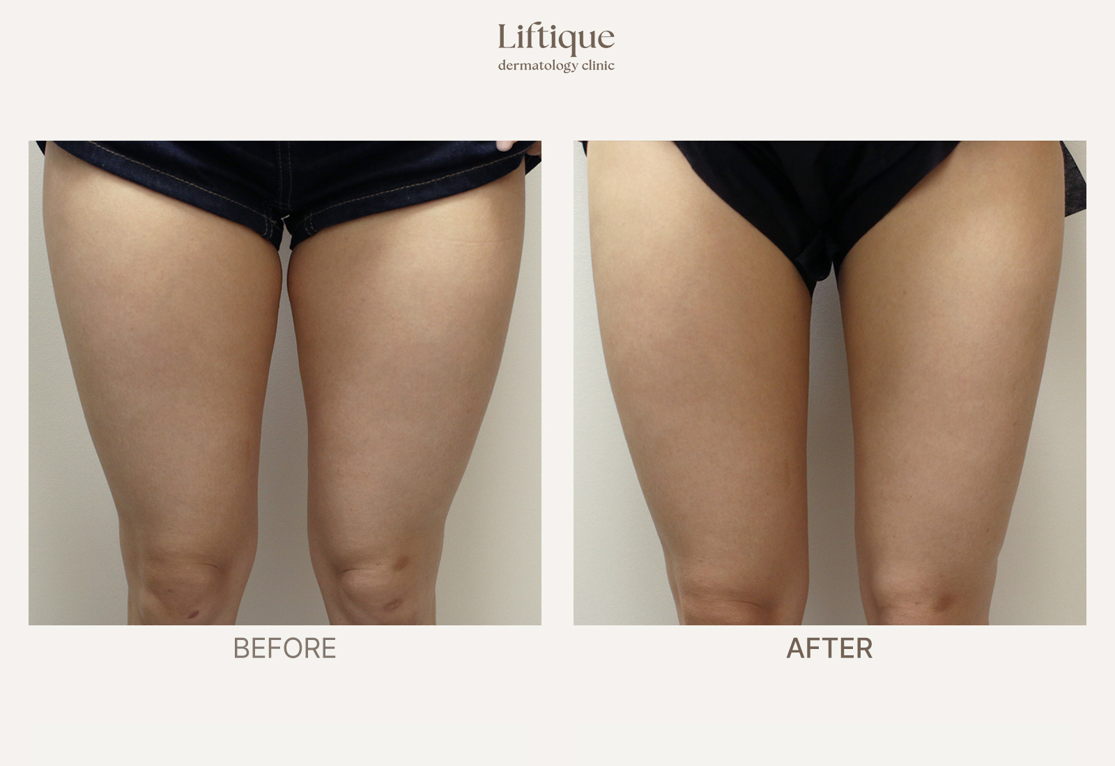 Before-and-after result 1 for Body ONDA at Liftique Dermatology Clinic