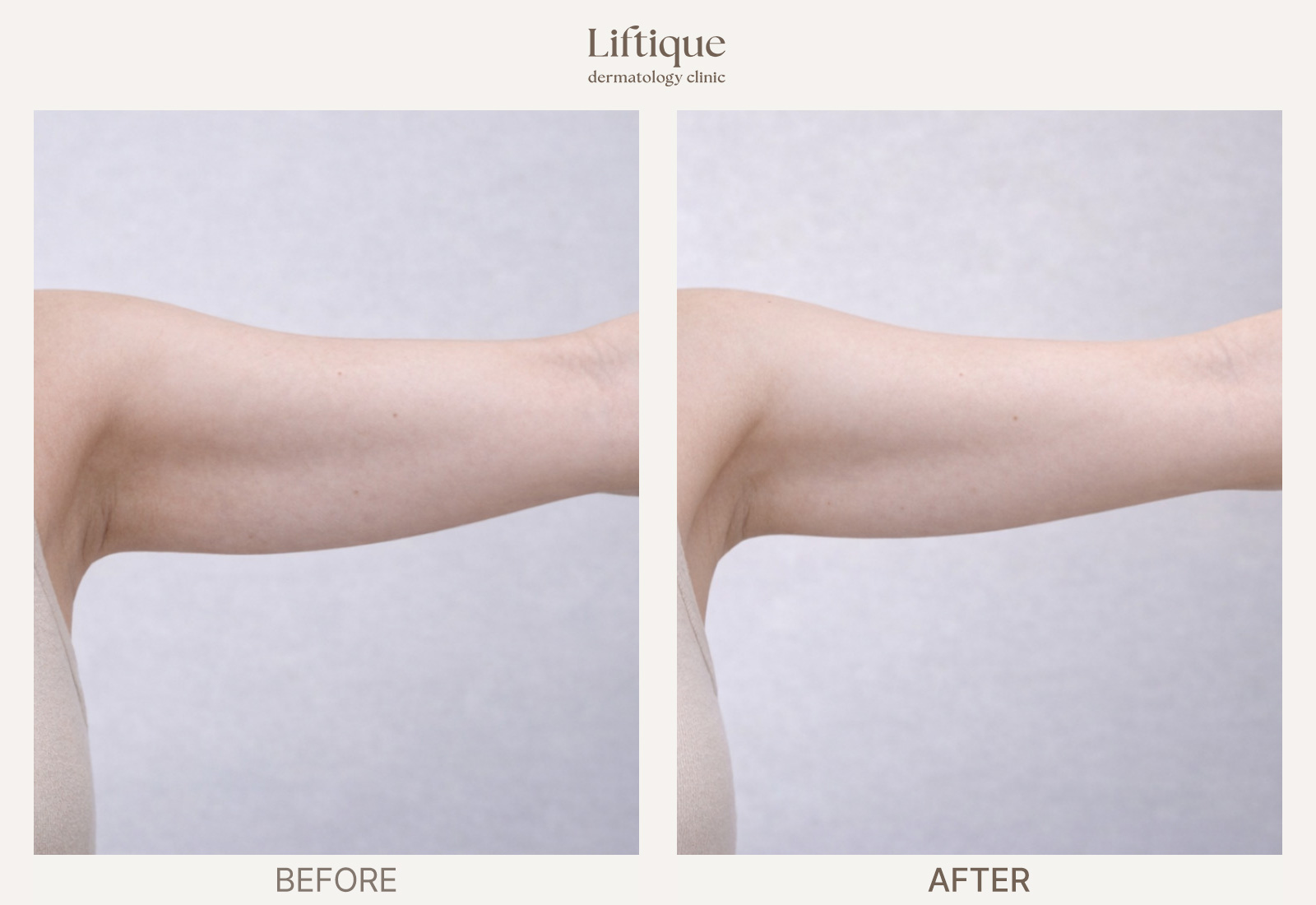 Before-and-after result 1 for Fat Dissolving Injection at Liftique Dermatology Clinic