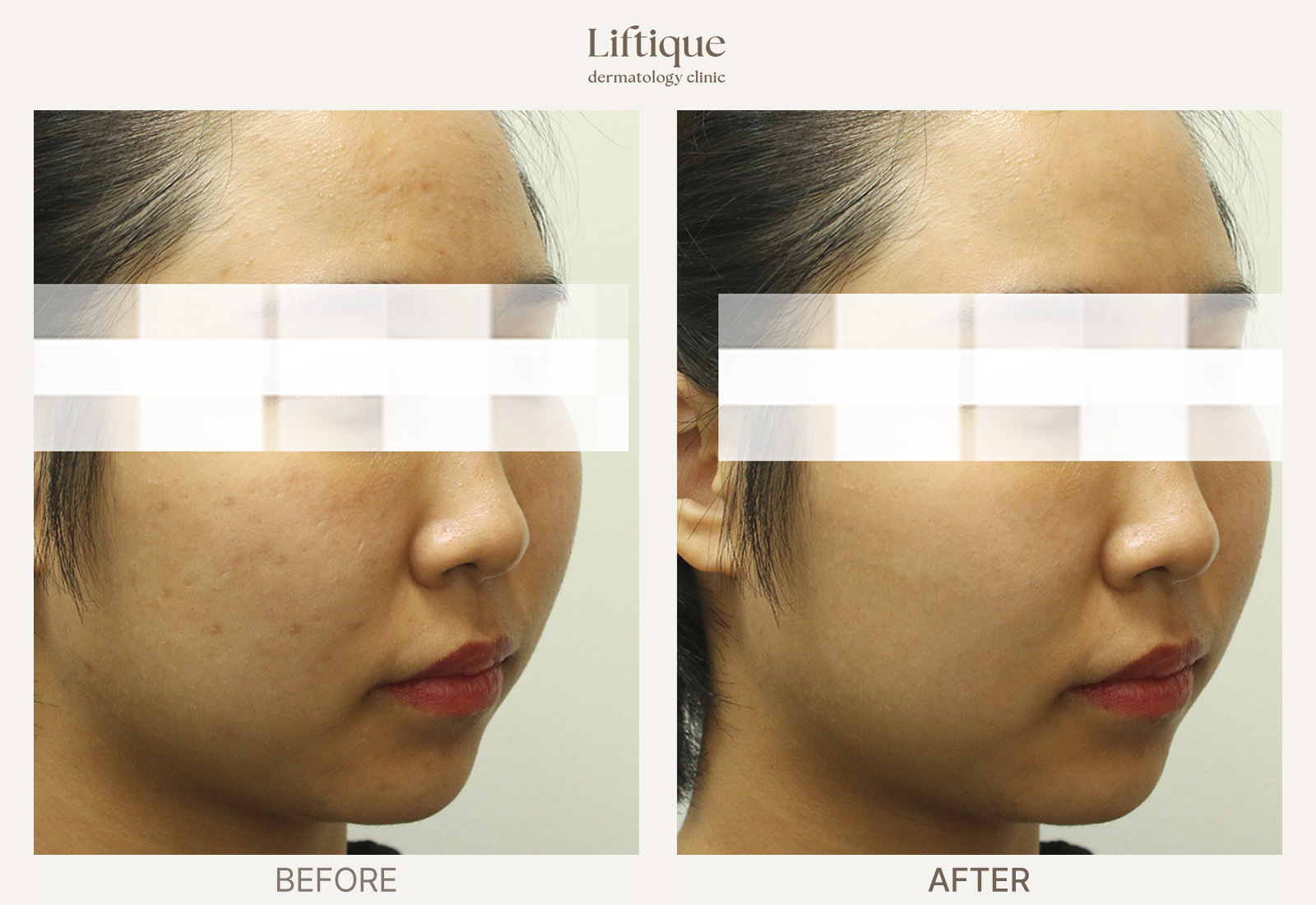 Before-and-after result 2 for Acne Scar Combination Program at Liftique Dermatology Clinic