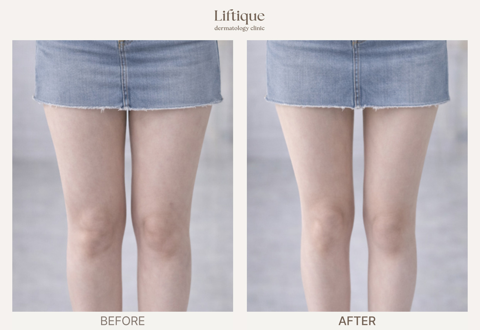 Before-and-after result 2 for Fat Dissolving Injection at Liftique Dermatology Clinic