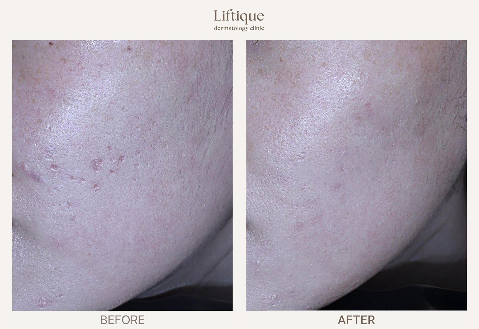 Before-and-after result 3 for Acne Scar Combination Program at Liftique Dermatology Clinic