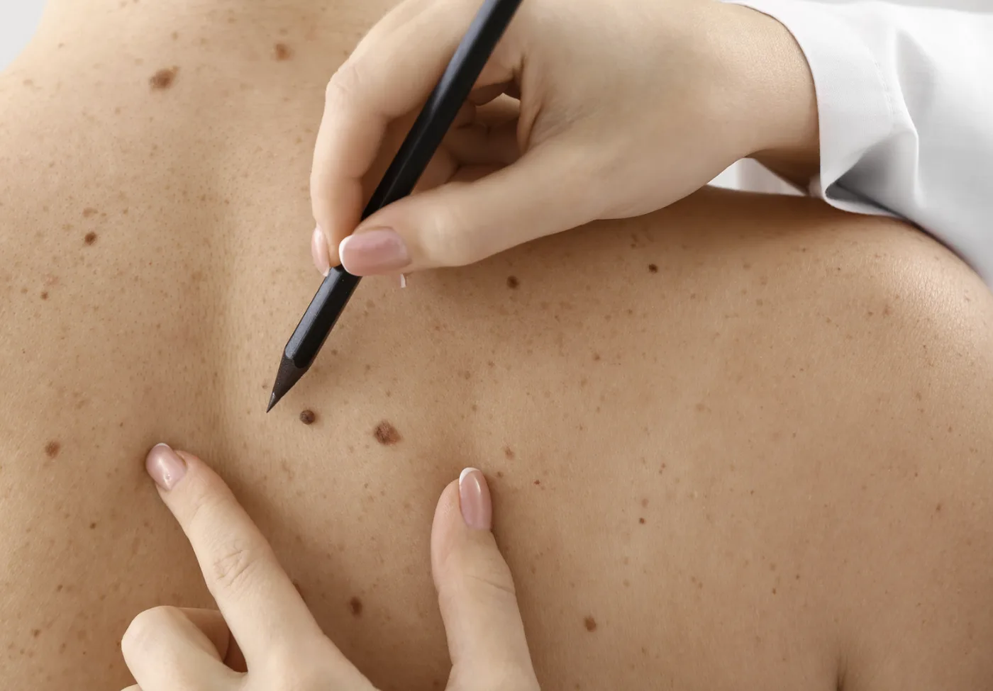 Doctor marking a spot on a patient's back during a skin check
