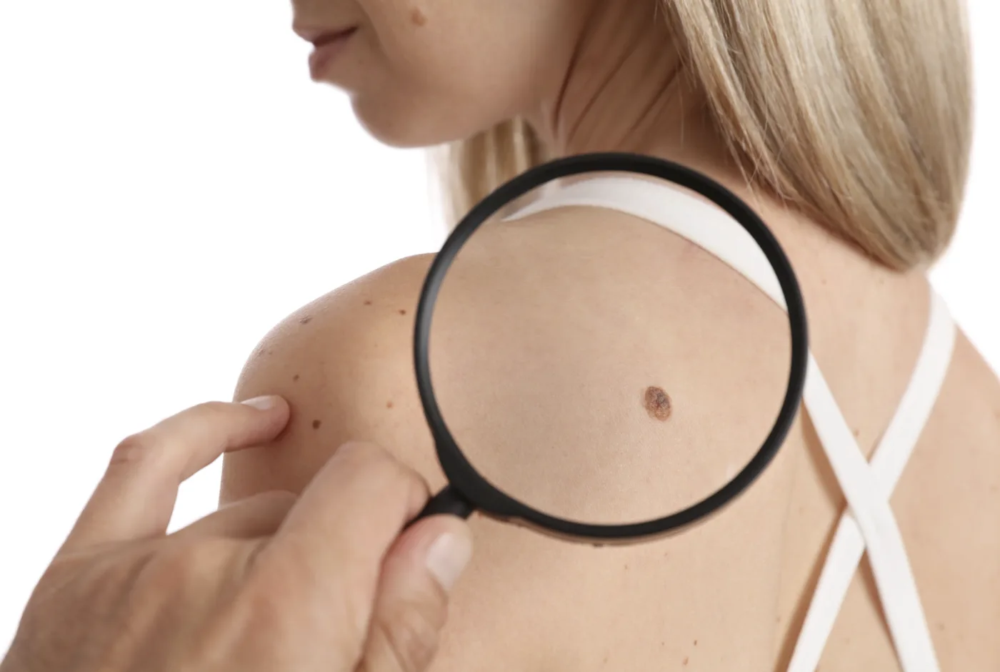 Close look at a mole on a patient's shoulder