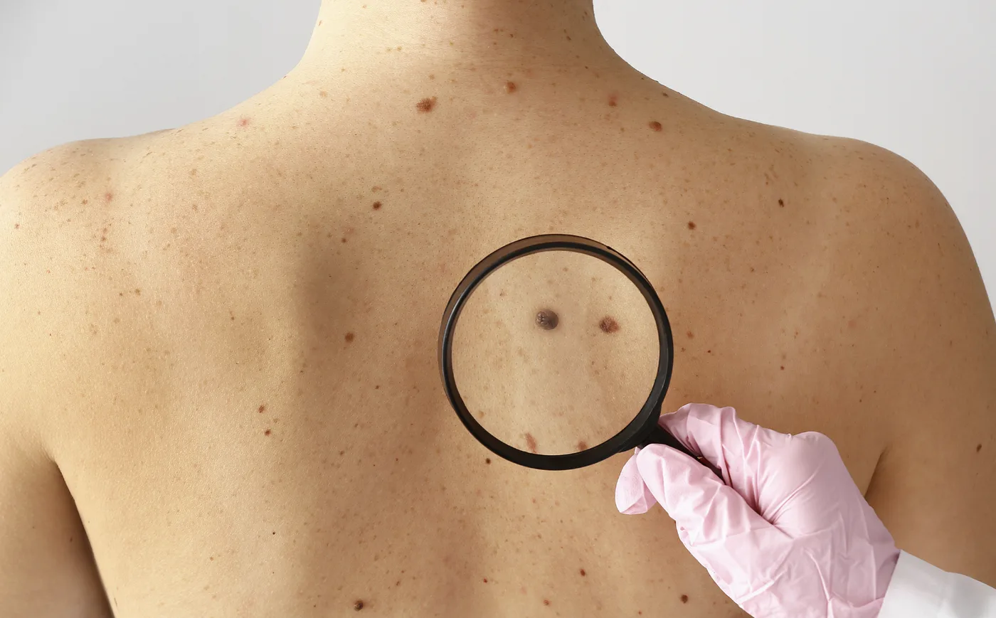 Checking moles on a patient's back during a full body skin check