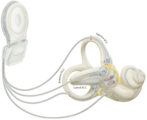 The VertiGo!-trial: towards an artificial balance organ