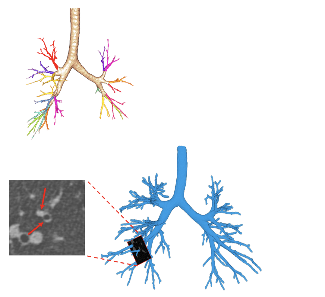 cystic fibrosis