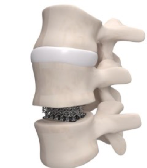 Spine Vision