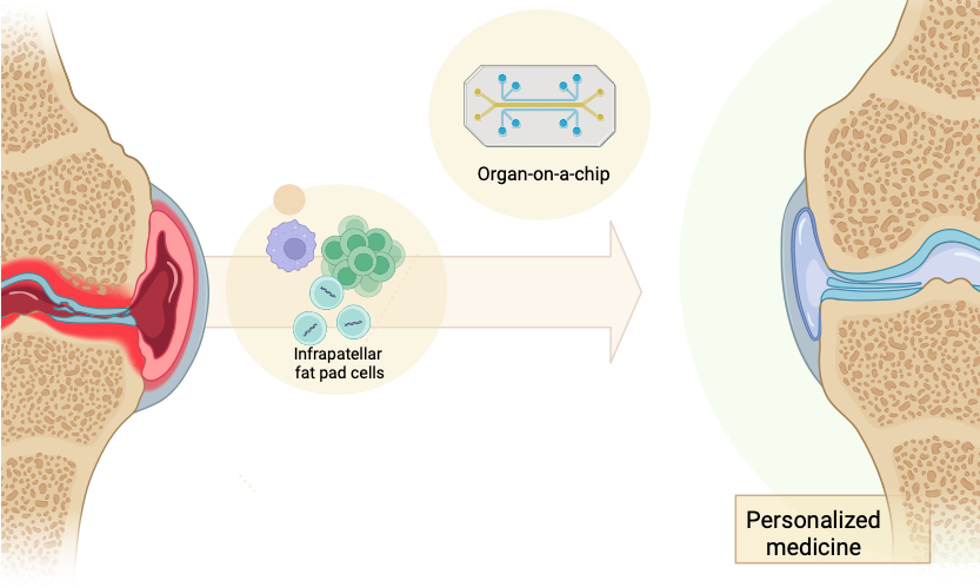 Targeting osteoarthritis with a joint-on-a-chip osteoarthritis microfluidic platform