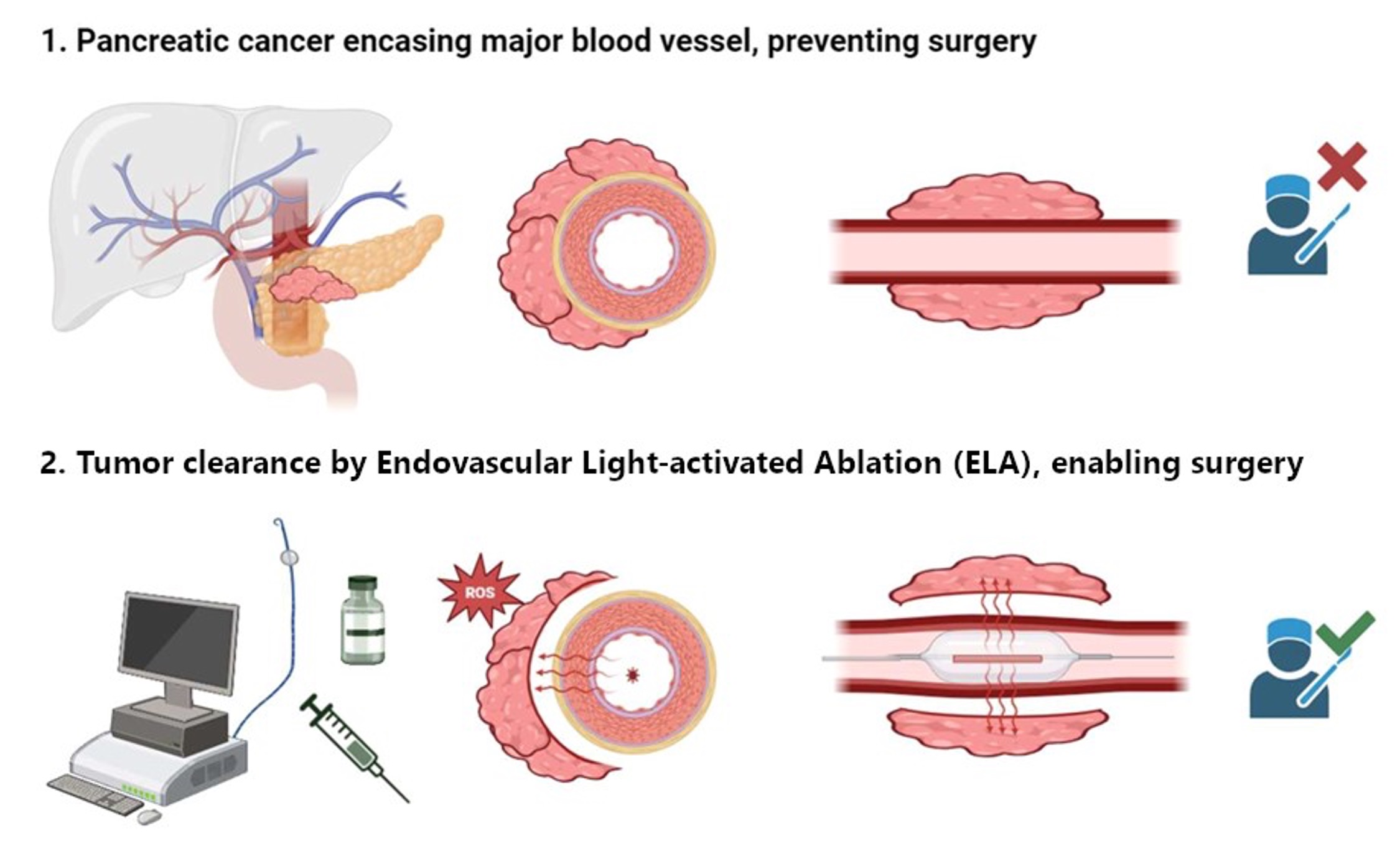 Downstaging locally advanced pancreatic cancer using endovascular light-activated ablation