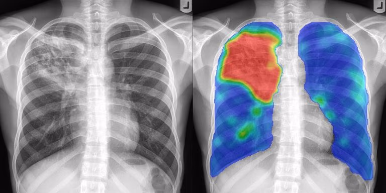 Van röntgenfoto naar snelle diagnose: hoe AI Tuberculose wereldwijd helpt bestrijden
