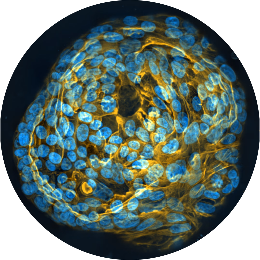 Near-Patient Platform for CAR-NK Therapy Optimization in Ovarian Cancer