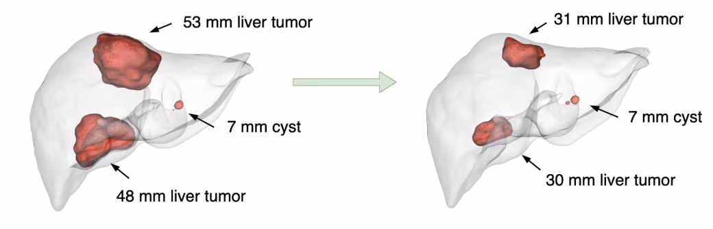 AI for automatic tumour response measurement on CT scans