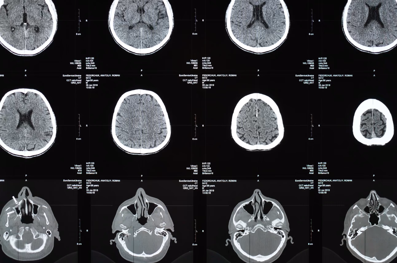 AI-Powered Clot insights for improved stroke treatment