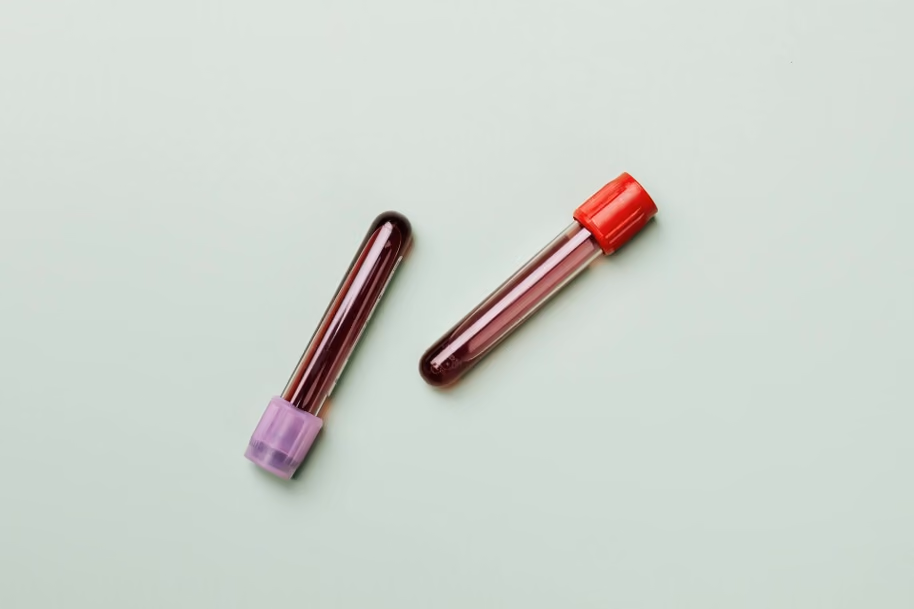 Improving Alzheimer’s blood tests by accounting for personal differences