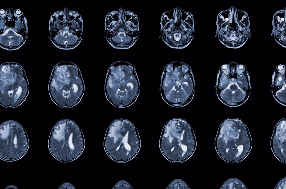 Safe and effective immunotherapy for glioblastoma