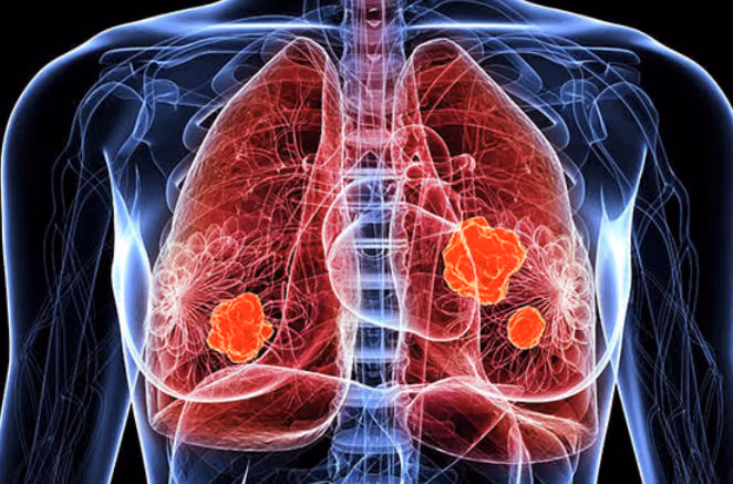 Improving our understanding and detection of lung cancer cachexia