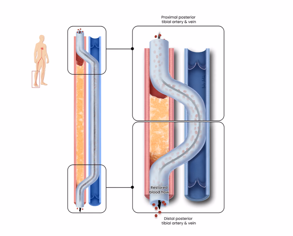 Regenerative Extraluminal Connection for Endovascular CTO Treatment