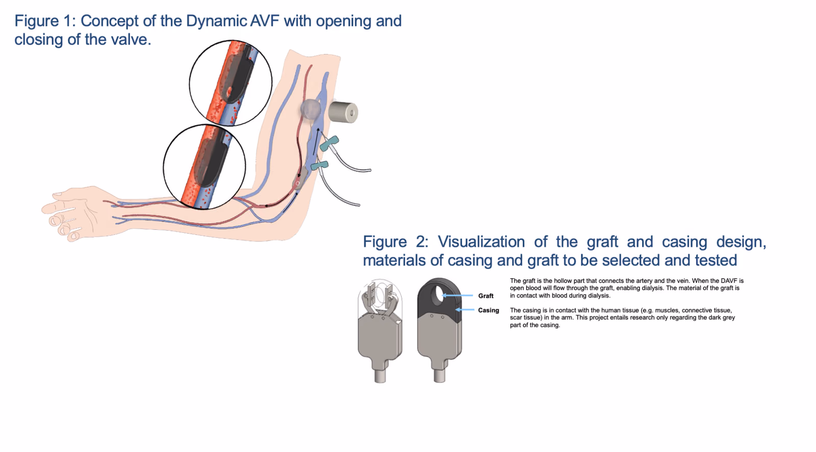 Optimizing Dynamic-AVF materials to Reduce foreign body