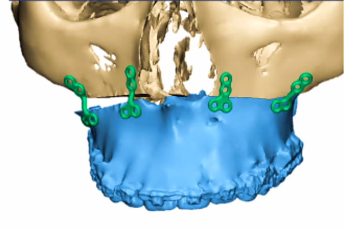 Patient Specific Osteosynthesis Trials