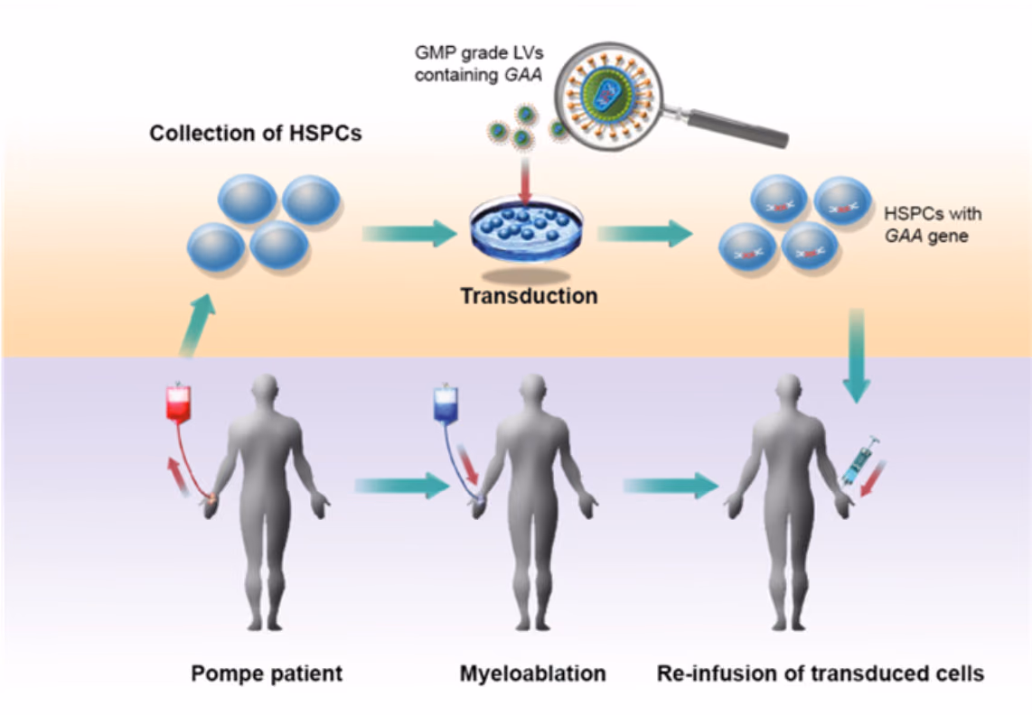 In-house production of lentiviral gene therapy for Pompe disease