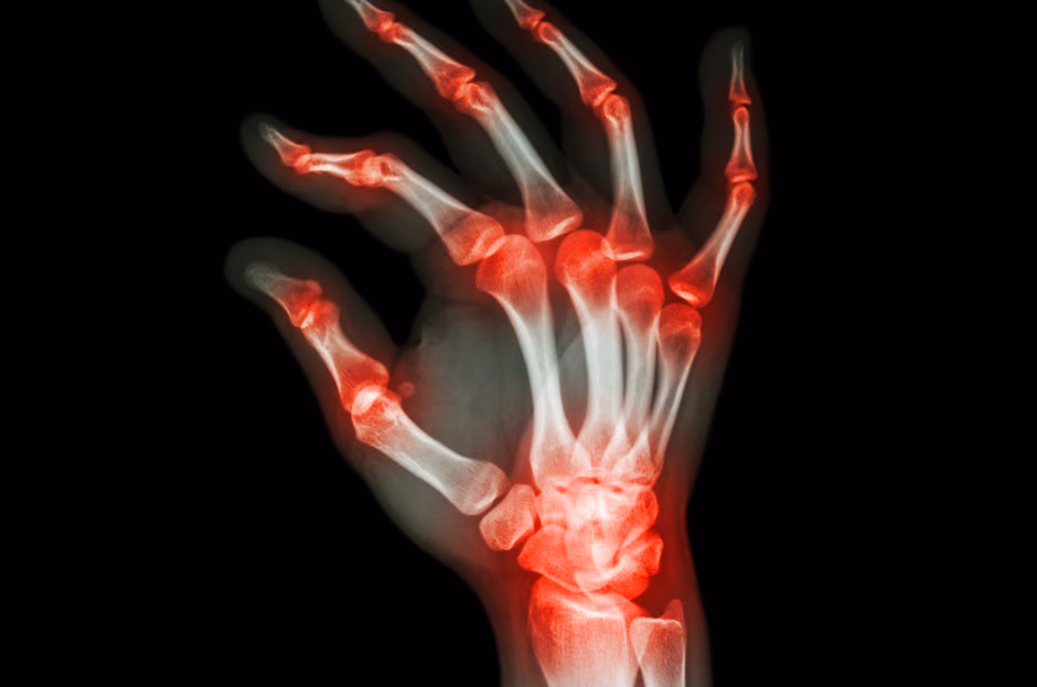 Personalized treatment for rheumatoid arthritis patients