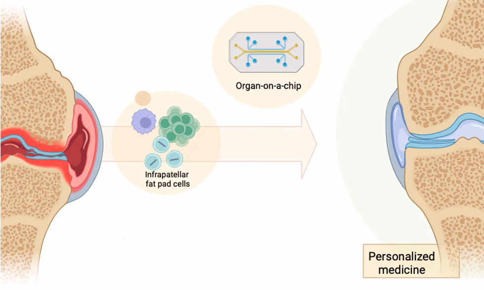 Targeting osteoarthritis with a joint-on-a-chip osteoarthritis microfluidic platform