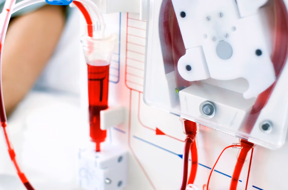 dialysis treatment