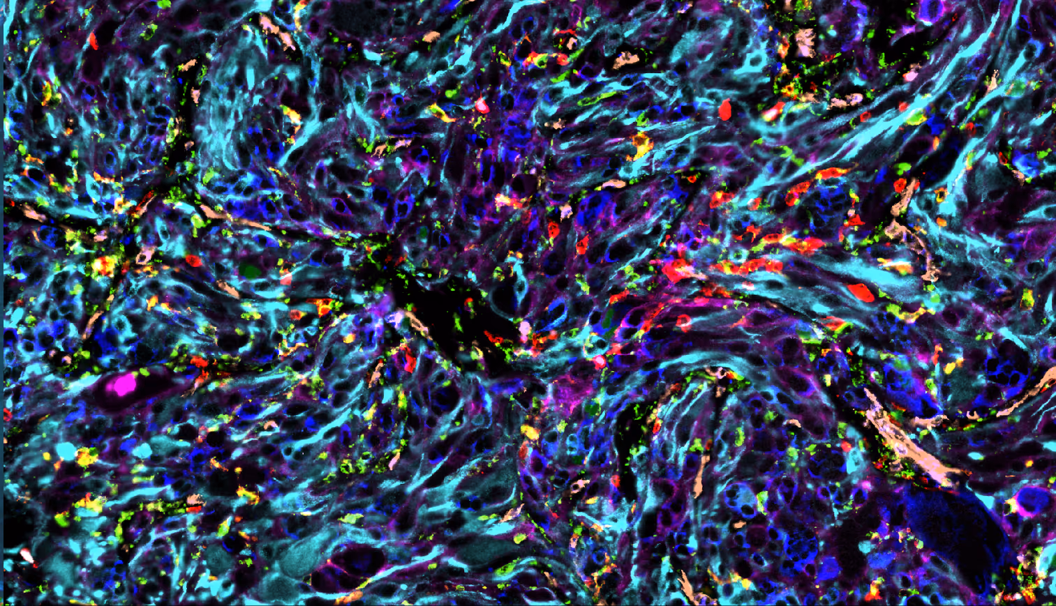 Spatial-omics imaging of paediatric solid tumours to enhance CAR-T therapy