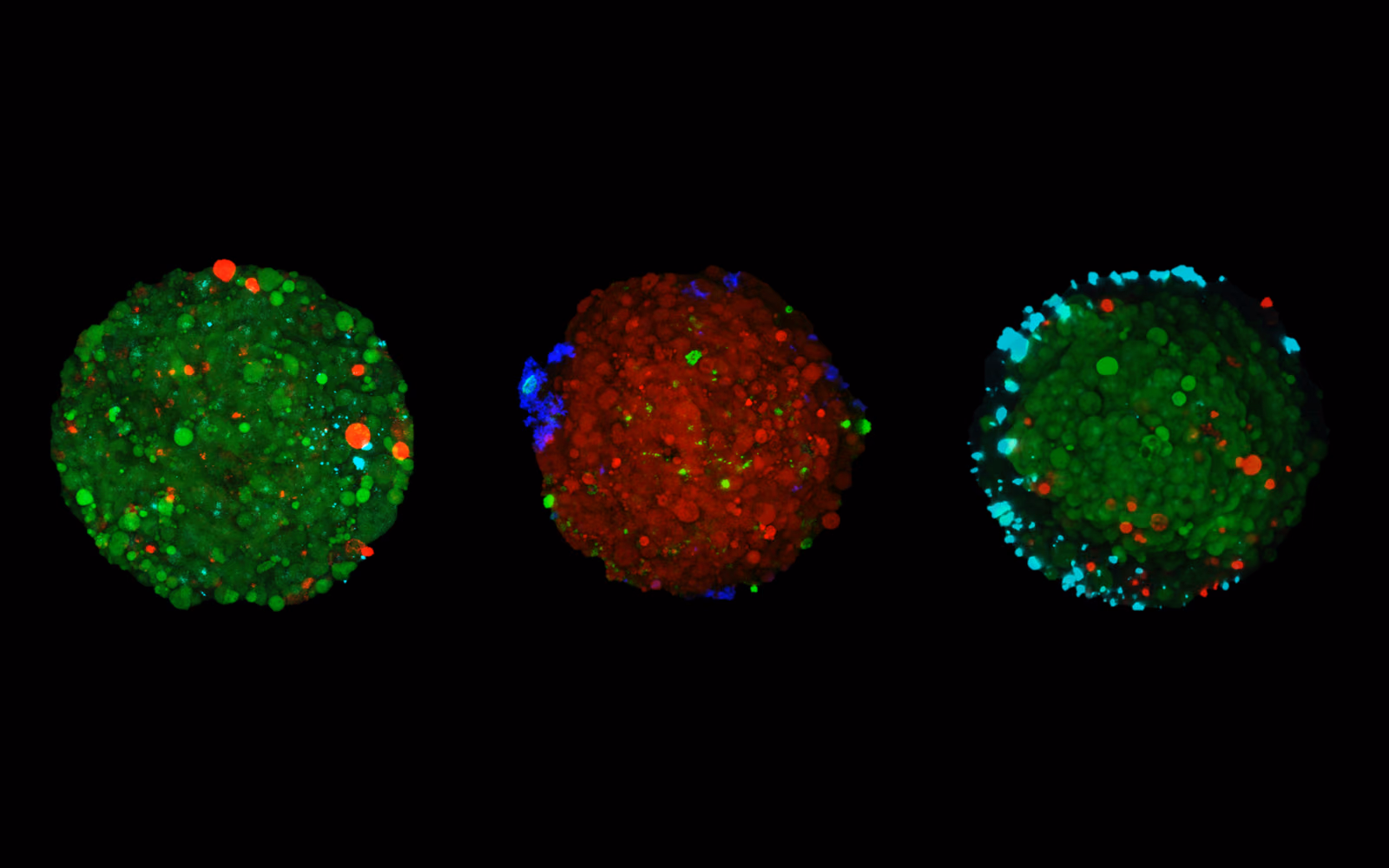 Enhancing Glioblastoma Treatment Using Local Injectable Hydrogels Containing Drug-Loaded Polymeric Particles