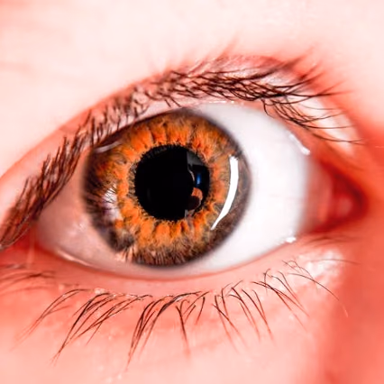 A novel therapy to treat severe myopia