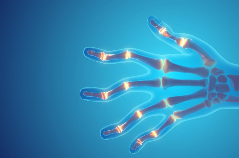 The relation between Neutrophil Extracellular Trap levels and disease state in Rheumatoid Arthritis