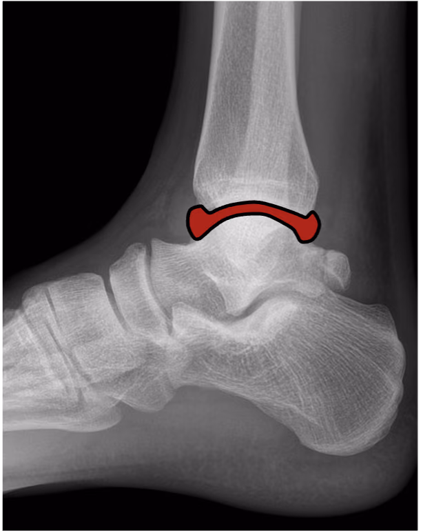 Injectable polymers as cushions to treat osteoarthritis (InOrtho)