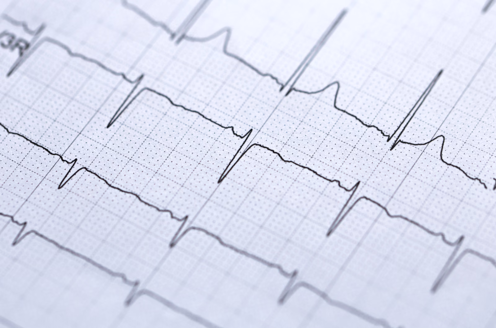 Predicting occlusive myocardial infarction using deep learning based algorithms for the electrocardiogram
