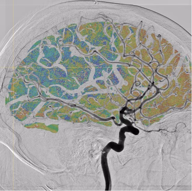 Q-Maestro: Quantification of brain reperfusion in X-ray images in endovascular treatment of stroke patients