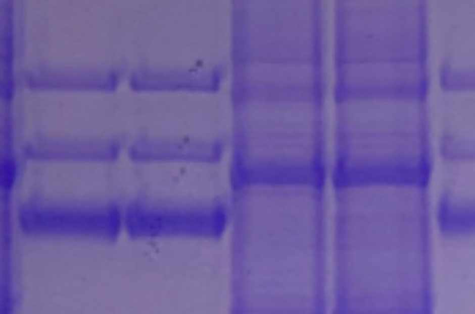 Gene therapy for hereditary angioedema (HAE-CURE)