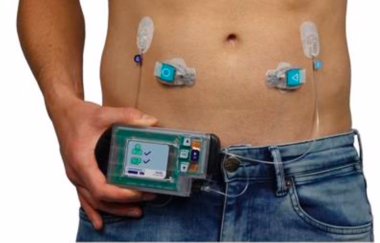 Glucose control through a bihormonal artificial pancreas in patients after total pancreatectomy (PANORAMA): randomized controlled crossover trial